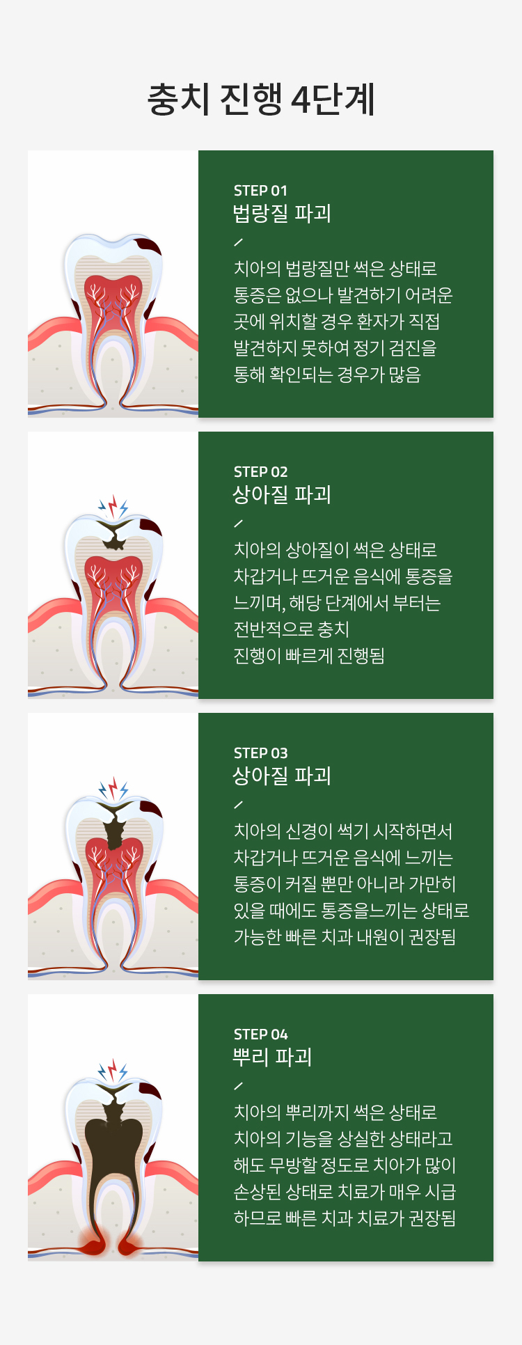 충치 진행 4단계