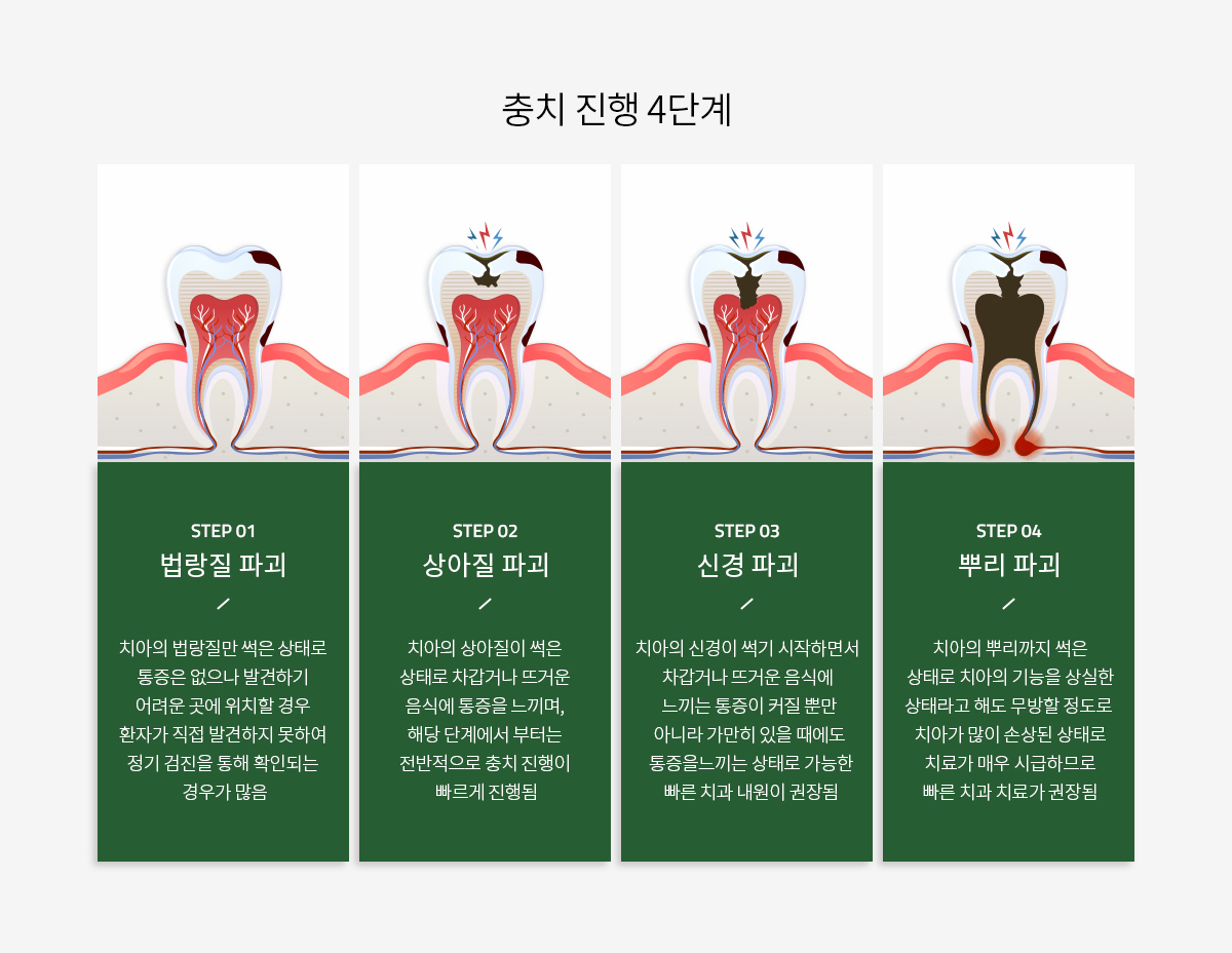 충치 진행 4단계